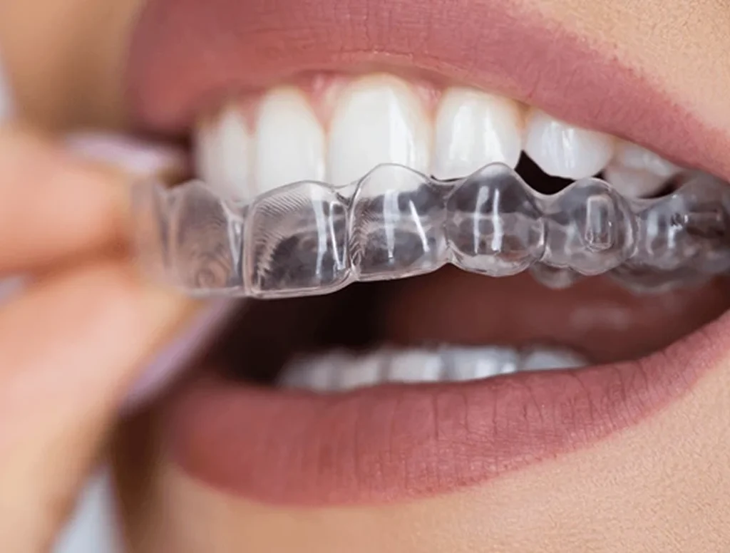 clearcorrect aligners in orlando, fl