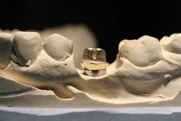 custom abutments in orlando, fl