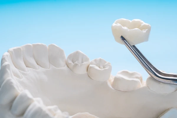 dental crowns in orlando, fl