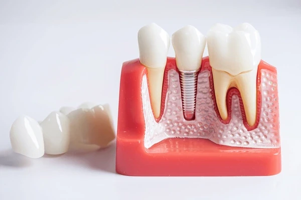 dental implants in orlando, fl
