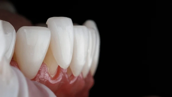 emax veneers in orlando, fl