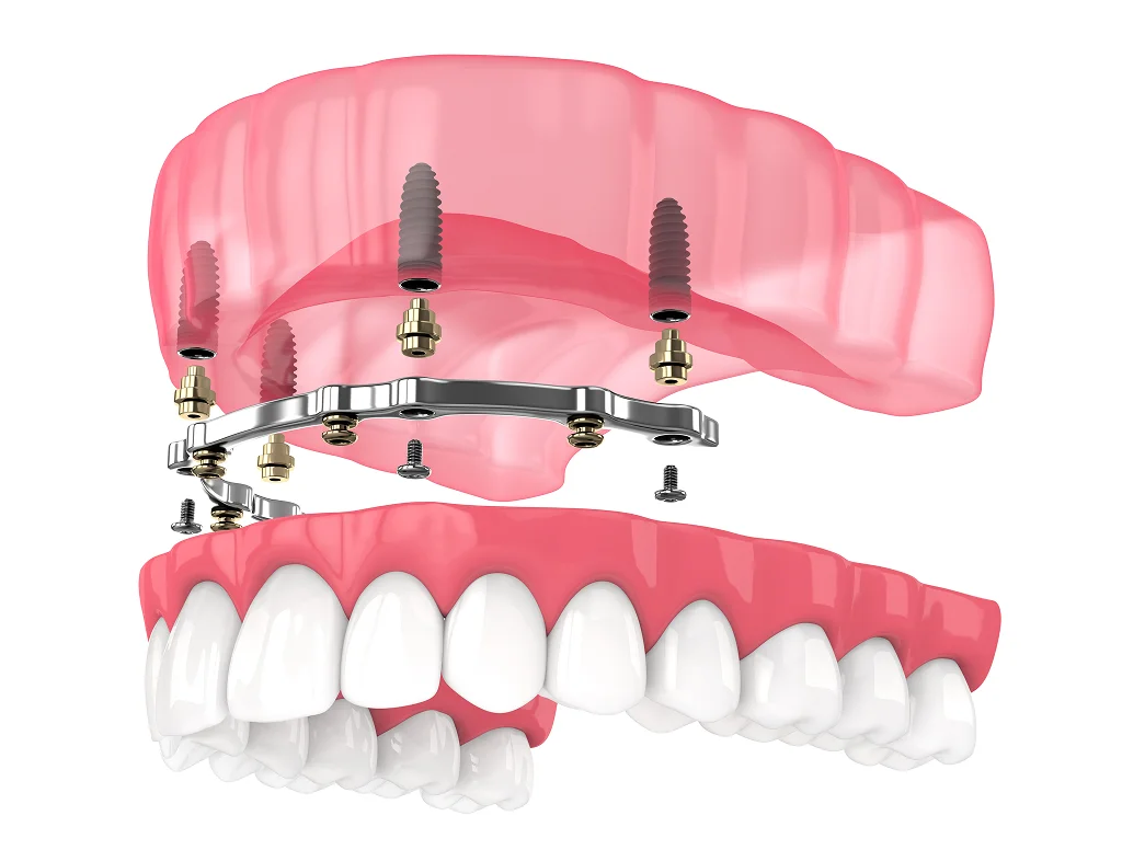 implant overdentures in orlando, fl