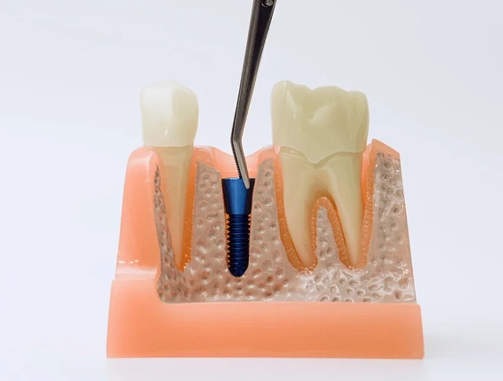 implant placement in orlando, fl