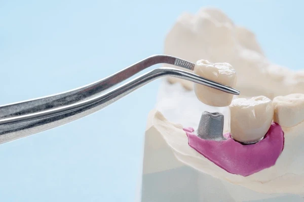 implant restorations in orlando, fl