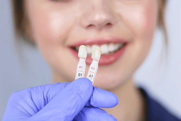 no prep veneers in orlando, fl