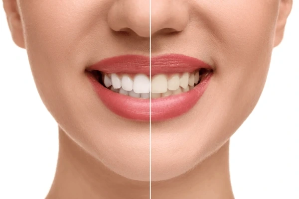 teeth whitening in orlando, fl