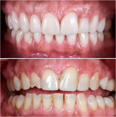 affordable teeth whitening at our dental clinic in olrlando fl