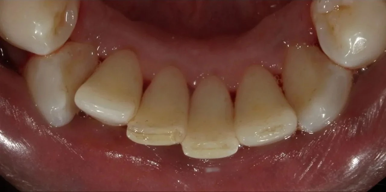 after close up intraoral view of clean polished lower front teeth after dental scaling