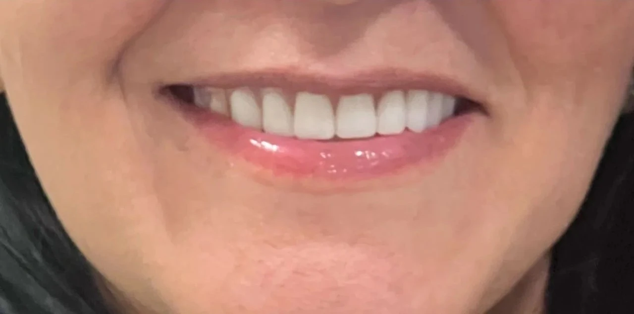 after smile view of complete bright upper restoration with natural uniform smile