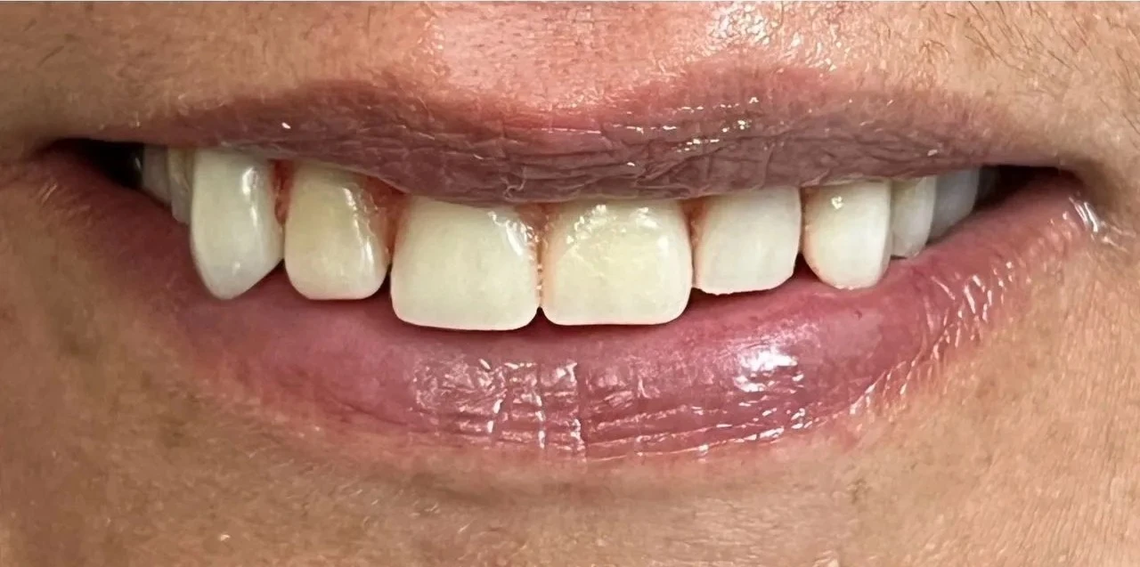 after smile view of restored upper arch with full porcelain restorations