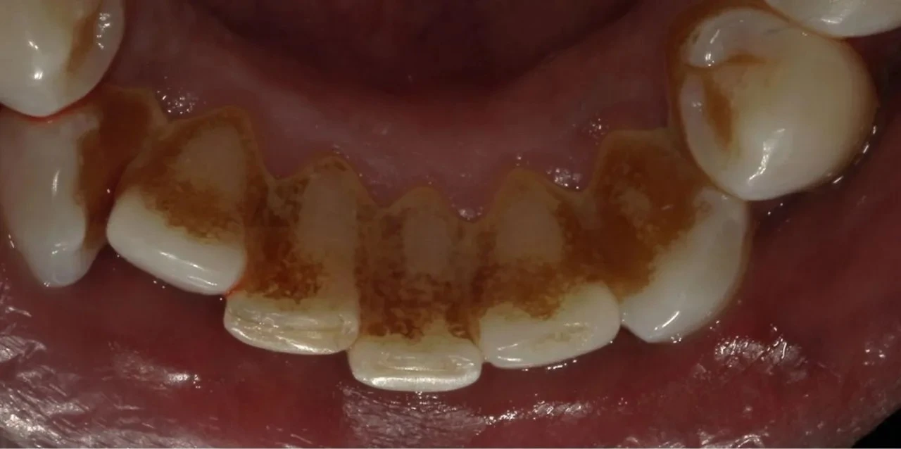 before close up intraoral view of heavy brown tartar and staining on lower front teeth