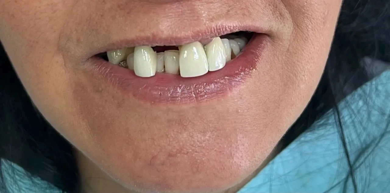 before smile view of missing front tooth space with discolored worn adjacent teeth