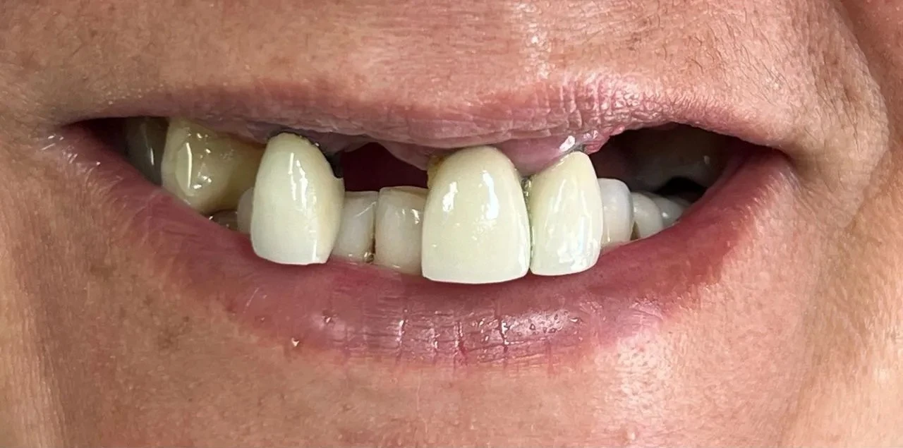 before smile view of uneven worn front teeth with visible discoloration